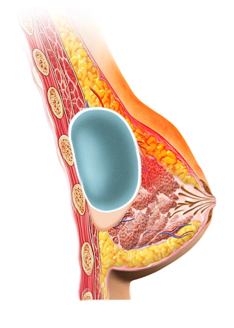 Breast implant diagram for 345 plastic surgery where natural results are achieved.