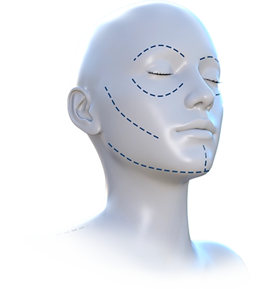 Facelift 345 plastic surgery diagram showing incision lines for natural results