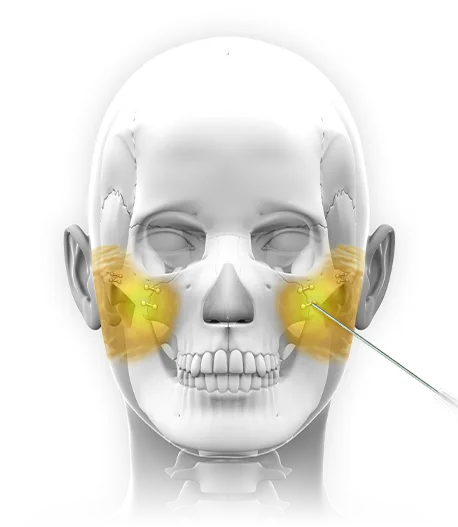 345 Plastic Surgery where natural skull with cheek augmentation for facial plastic surgery