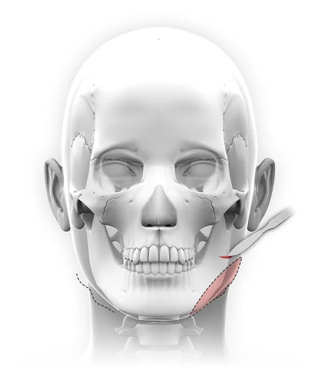 345 Plastic Surgery where natural face skull with surgical markings for plastic surgery procedure