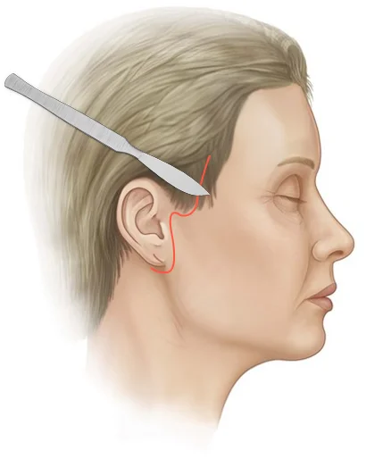Facelift diagram showing incision for plastic surgery where natural 345.