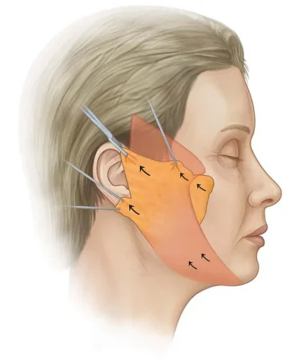 Facelift diagram showing natural 345 plastic surgery procedure.