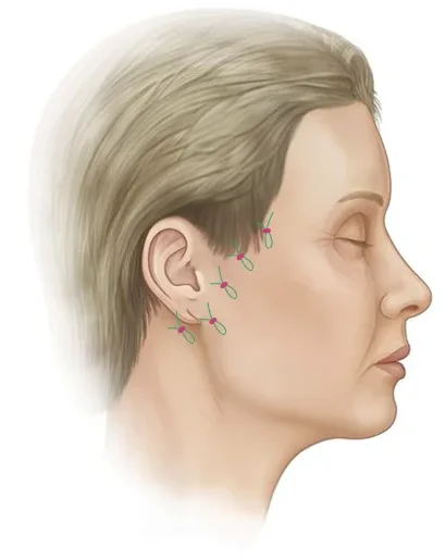 345 Plastic Surgery face lift diagram showing natural looking results.