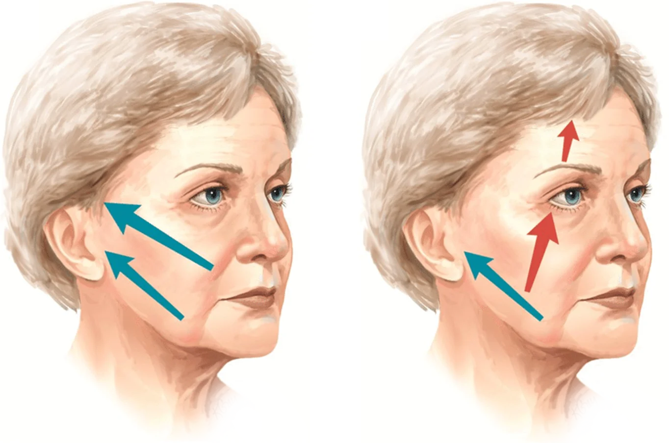 345 Plastic Surgery where natural facelift diagram showing before and after results.