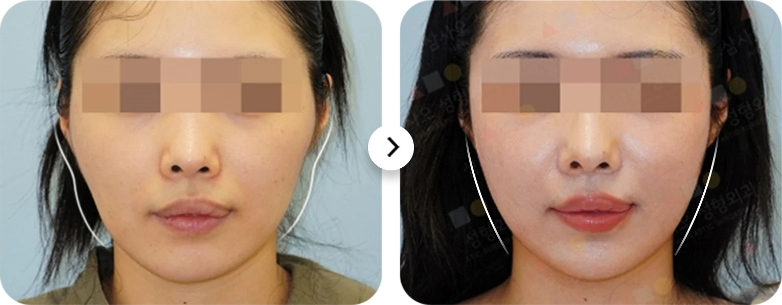 Before and after 345 Plastic Surgery where natural, showing face contouring results.