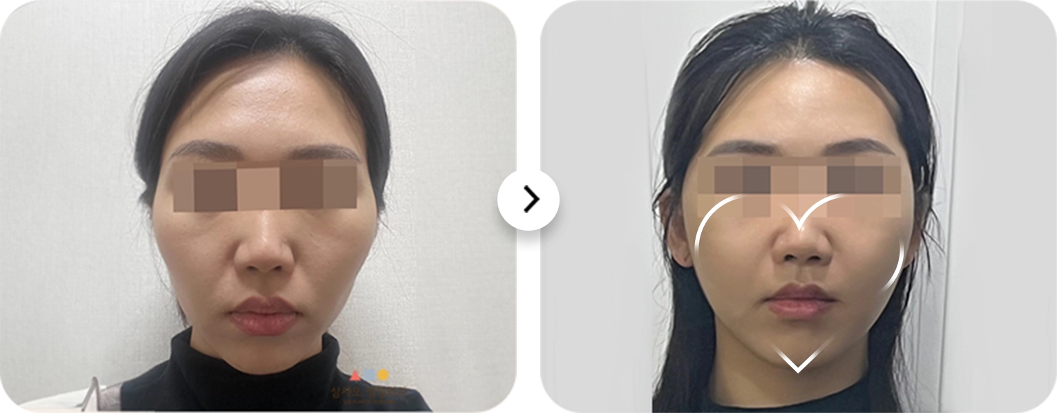 Before and after 345 plastic surgery for a more natural look. Face contouring results.