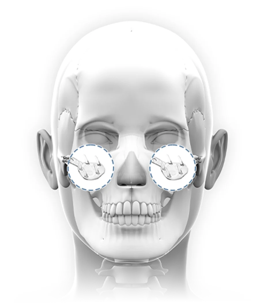 Orbital rim implant for natural 345 Plastic Surgery where natural. Skull showing implant placement.