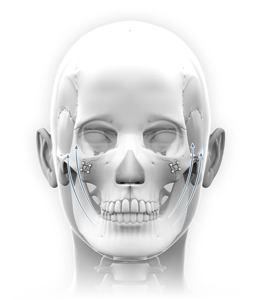 Facial bone structure diagram for 345 plastic surgery where natural.