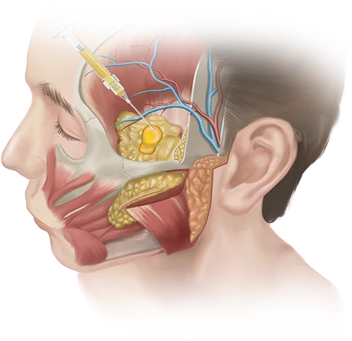 345 Plastic surgery injection for natural face lift. Facial plastic surgery diagram.