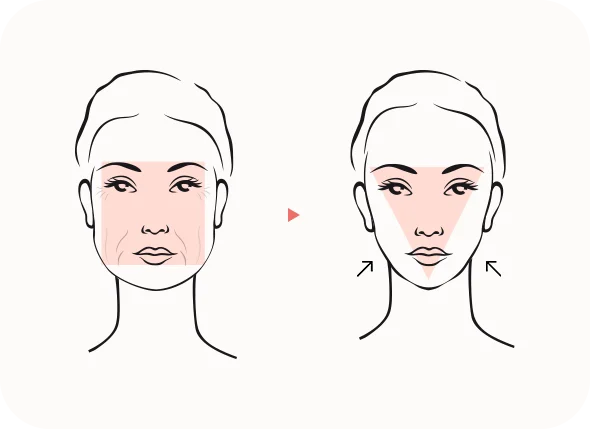 Before and after 345 plastic surgery illustration showing natural face lift results.