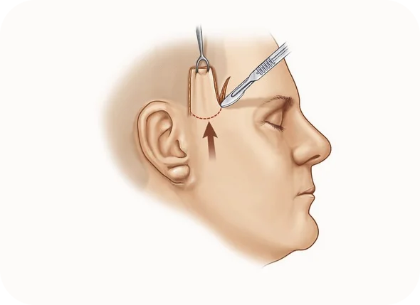 345 Plastic Surgery scalp lift illustration where natural hairline is restored.