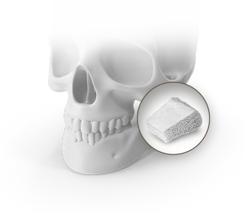 Skull with bone graft for 345 plastic surgery where natural facial reconstruction