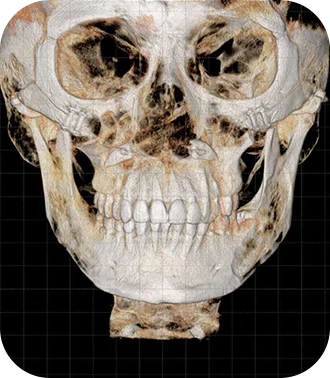 345 Plastic Surgery where natural human skull CT scan for plastic surgery evaluation