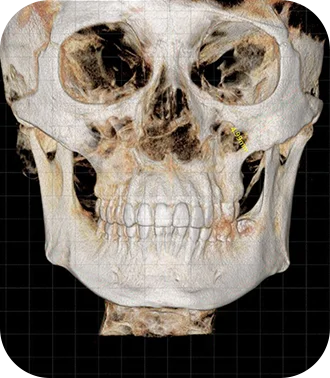 3D CT scan of a human skull for plastic surgery where natural.