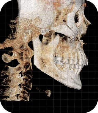3D CT scan of skull for plastic surgery. Natural results with 345 plastic surgery.