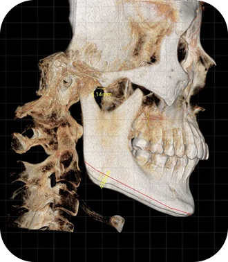 3D CT scan of skull for plastic surgery. 345 Plastic Surgery where natural.