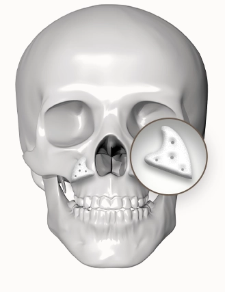 345 Plastic Surgery skull showing natural plastic surgery nasal implant.