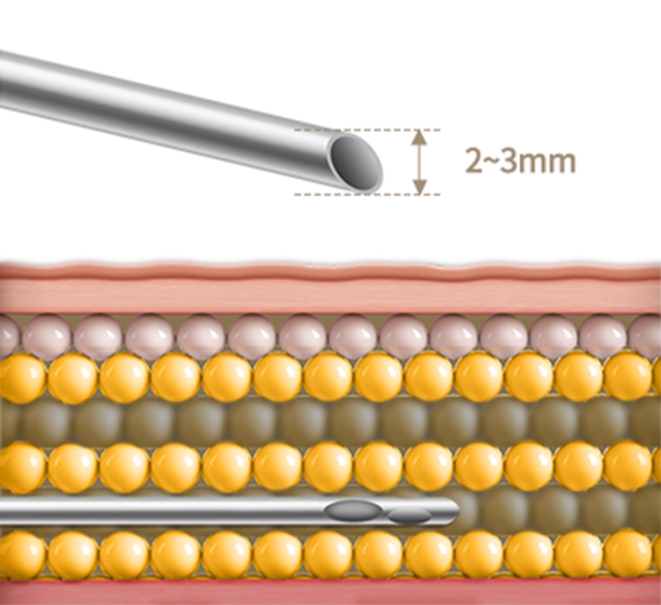 345 Plastic Surgery where natural; cannula injecting filler for plastic surgery. Natural results.