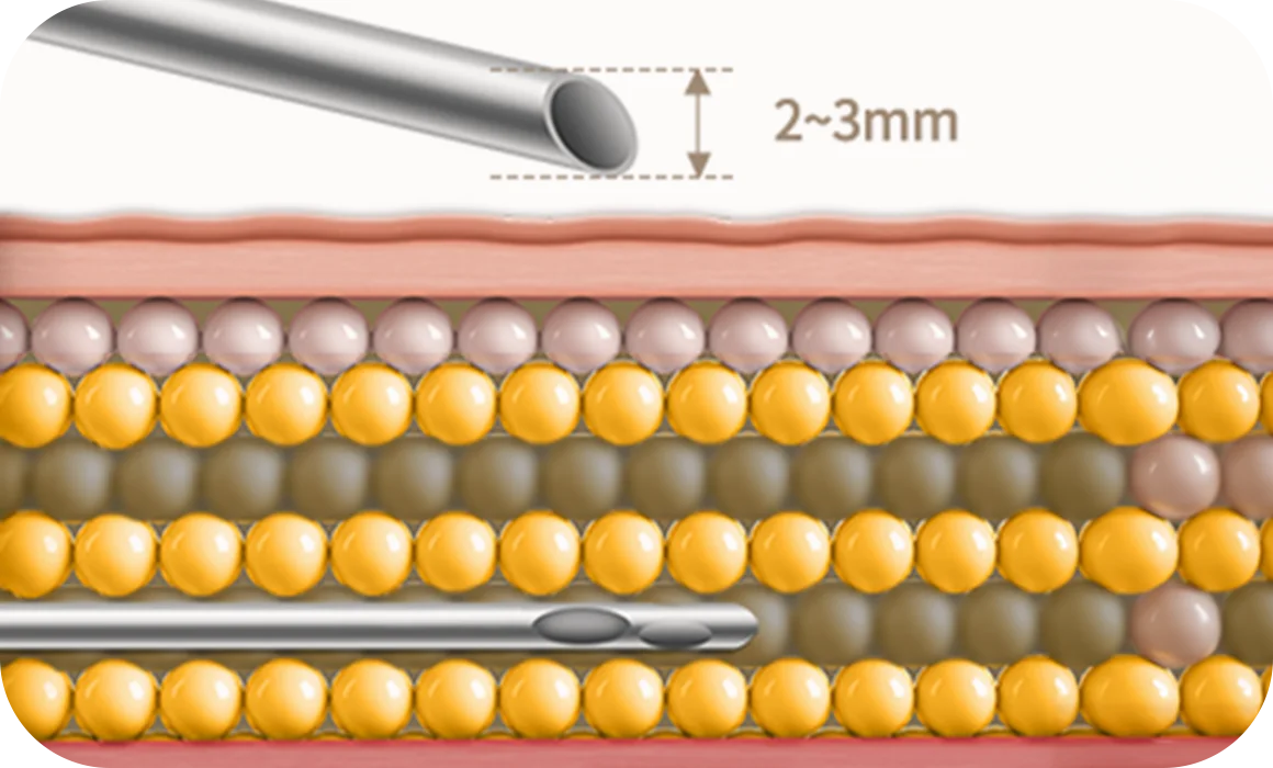345 Plastic Surgery liposuction cannula in fat layer for natural results