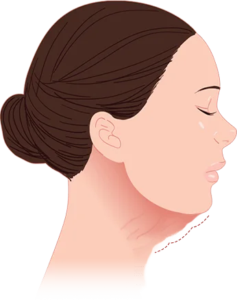 Woman with neck wrinkles for 345 Plastic Surgery where natural results.