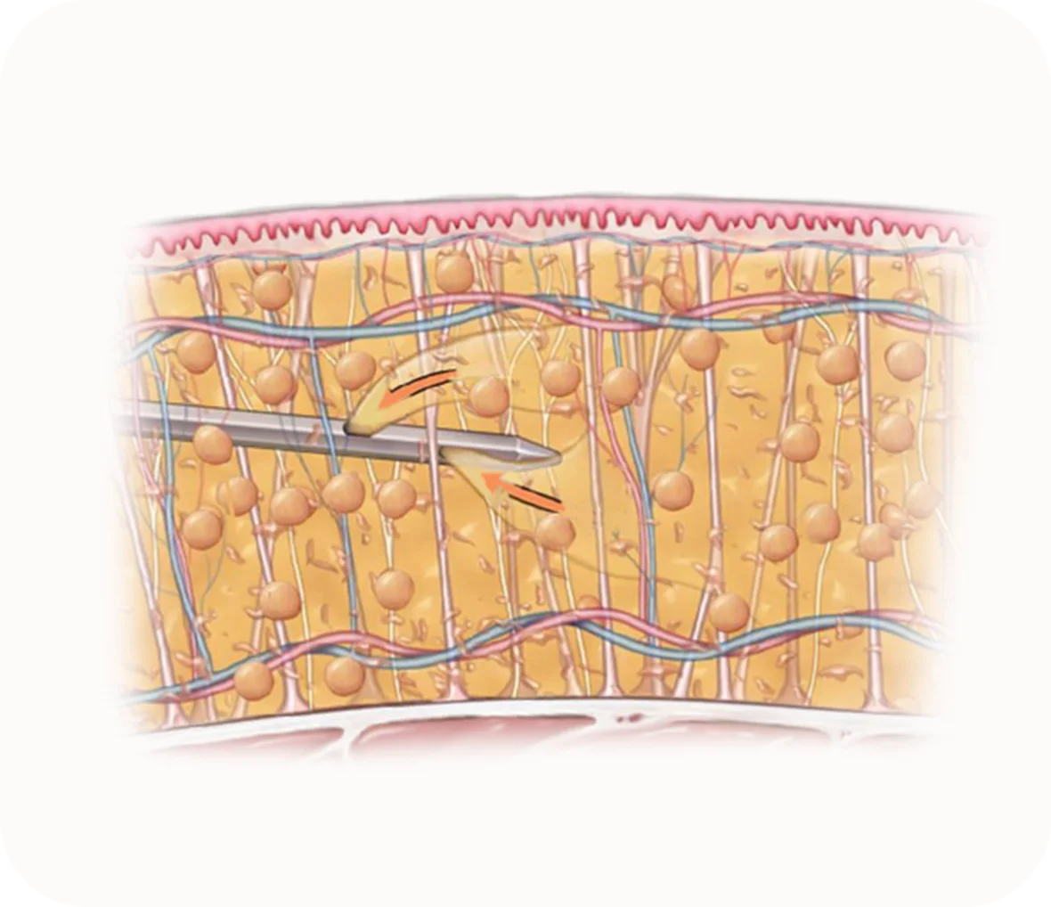 345 Plastic Surgery illustration of a needle injecting filler for natural looking results