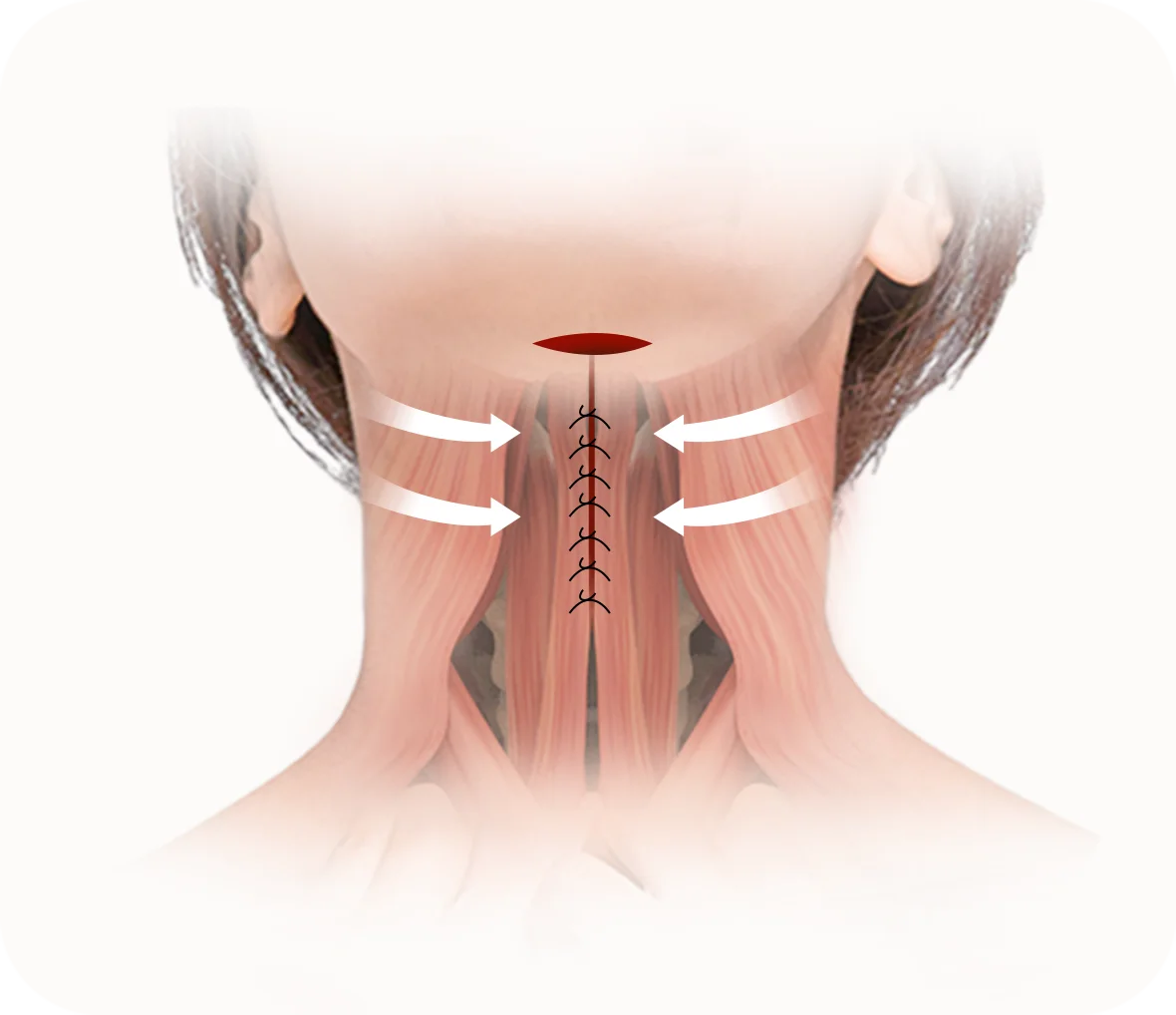 Neck lift plastic surgery diagram showing sutures and muscle tightening for natural results 345 Plastic Surgery