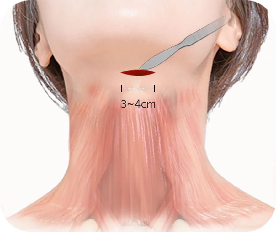 Neck surgery incision illustration with measurement.
