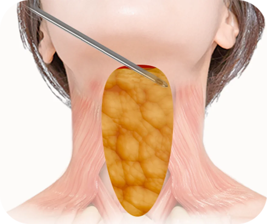 Thyroid gland anatomy illustration with needle.