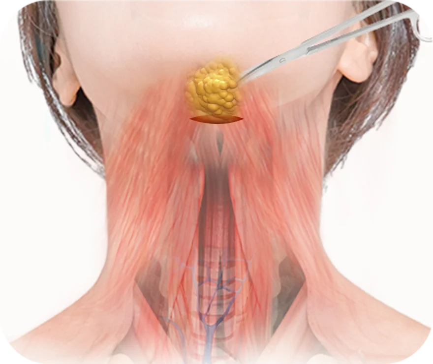 Illustration of neck liposuction procedure