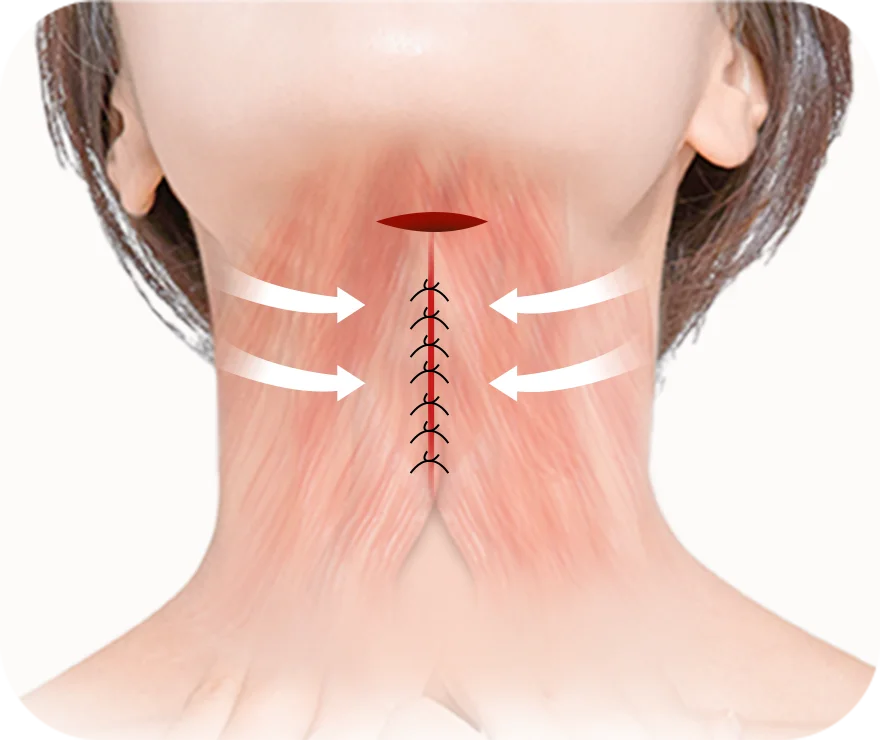 Neck surgery illustration with arrows and stitches.