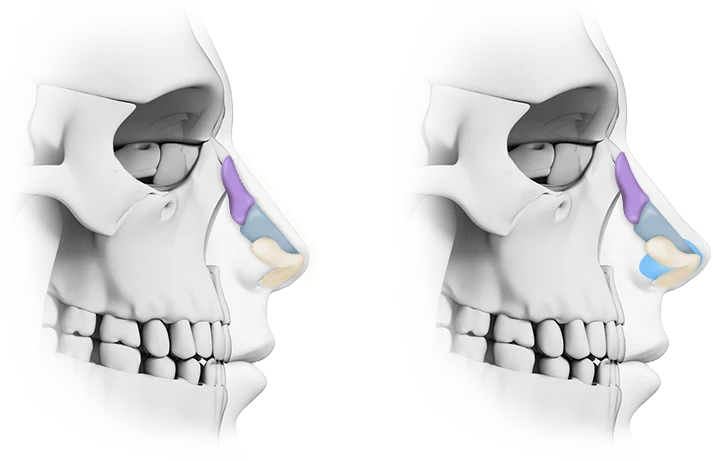 Skull showing nasal structure for plastic surgery 345. Natural results.