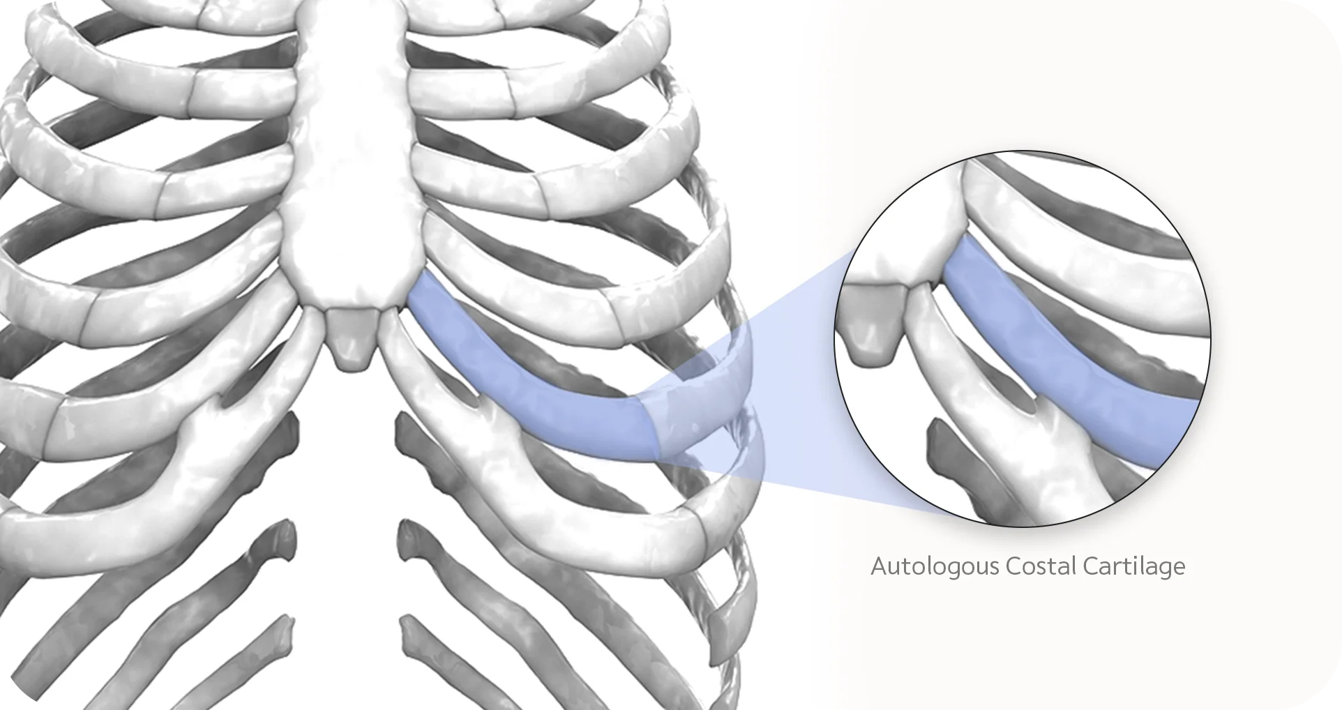 Autologous costal cartilage rib cage 345 plastic surgery where natural