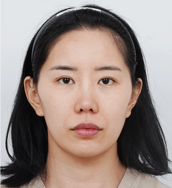 Asian woman before 345 plastic surgery for natural looking results