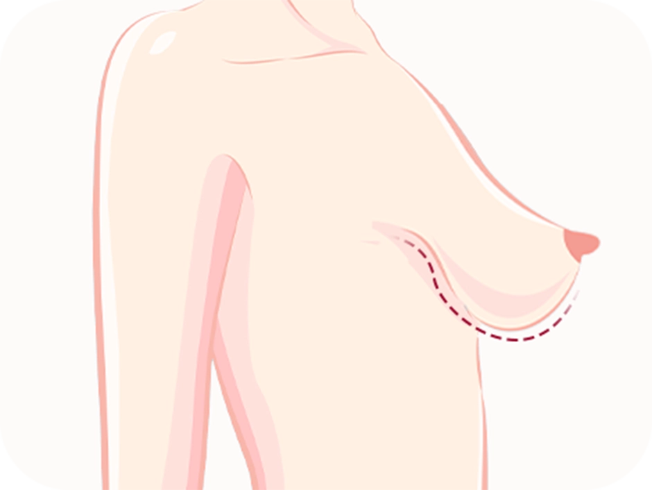 Illustration of breast ptosis for plastic surgery. 345 Plastic Surgery where natural.
