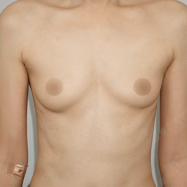 345 Plastic Surgery for natural looking breasts. Before and after breast augmentation plastic surgery.