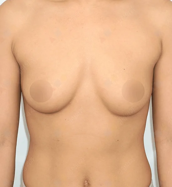 345 Plastic Surgery where natural breasts before breast augmentation plastic surgery
