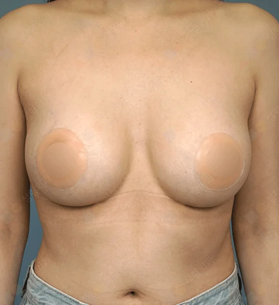 345 Plastic Surgery where natural breast augmentation for natural results
