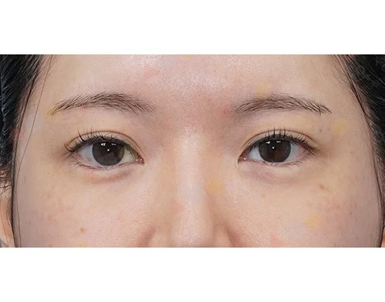Asian woman's eyes before 345 plastic surgery where natural.