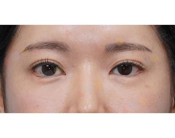 Asian woman eyes close up for 345 Plastic Surgery where natural results are visible.