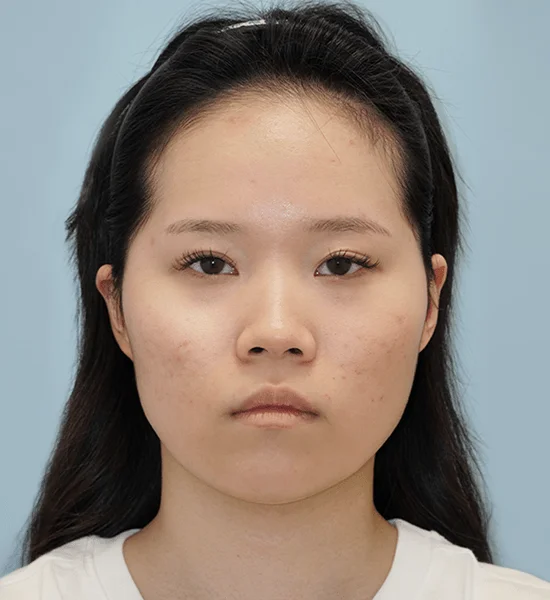 Asian woman's face before plastic surgery 345 Plastic Surgery where natural