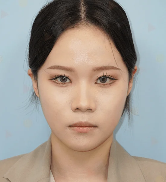 Asian woman face, 345 plastic surgery where natural looking results are achieved.