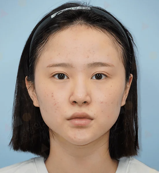 Asian woman before 345 plastic surgery for natural look. Facial skin with minor blemishes.