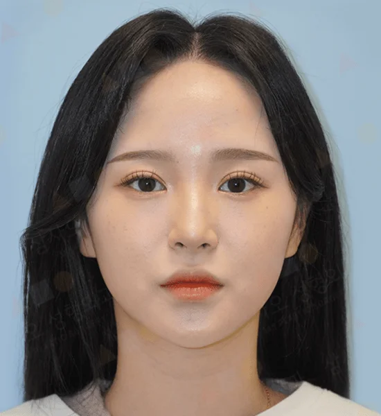 Asian woman face, 345 plastic surgery where natural results enhance beauty.
