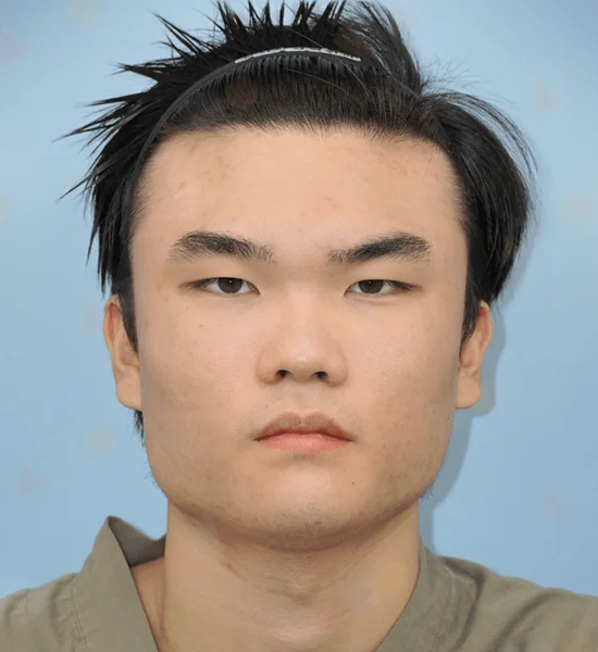 Asian man face, 345 plastic surgery where natural, before procedure.