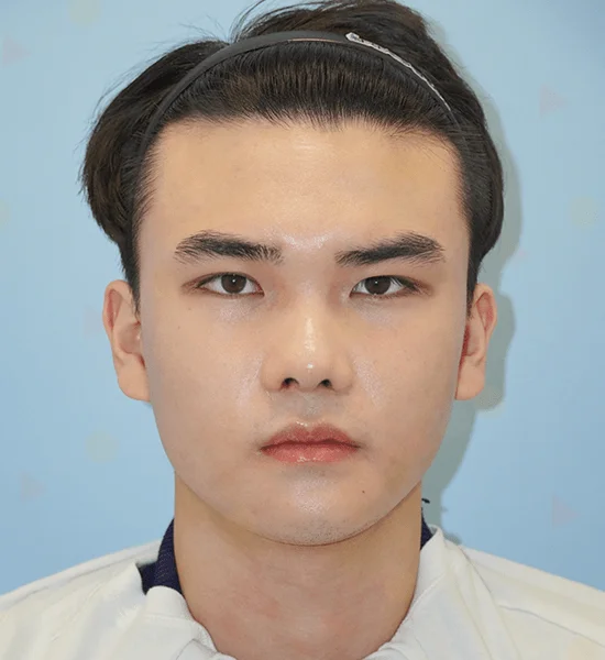 Asian man before 345 plastic surgery where natural looking results are achieved.