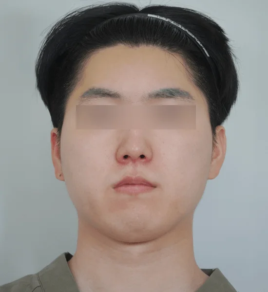 Asian man face before 345 plastic surgery where natural.