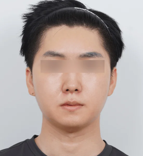 Asian man face before 345 plastic surgery where natural cosmetic procedure
