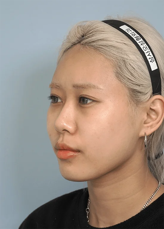 Asian woman with blonde hair, side profile. 345 Plastic Surgery where natural.