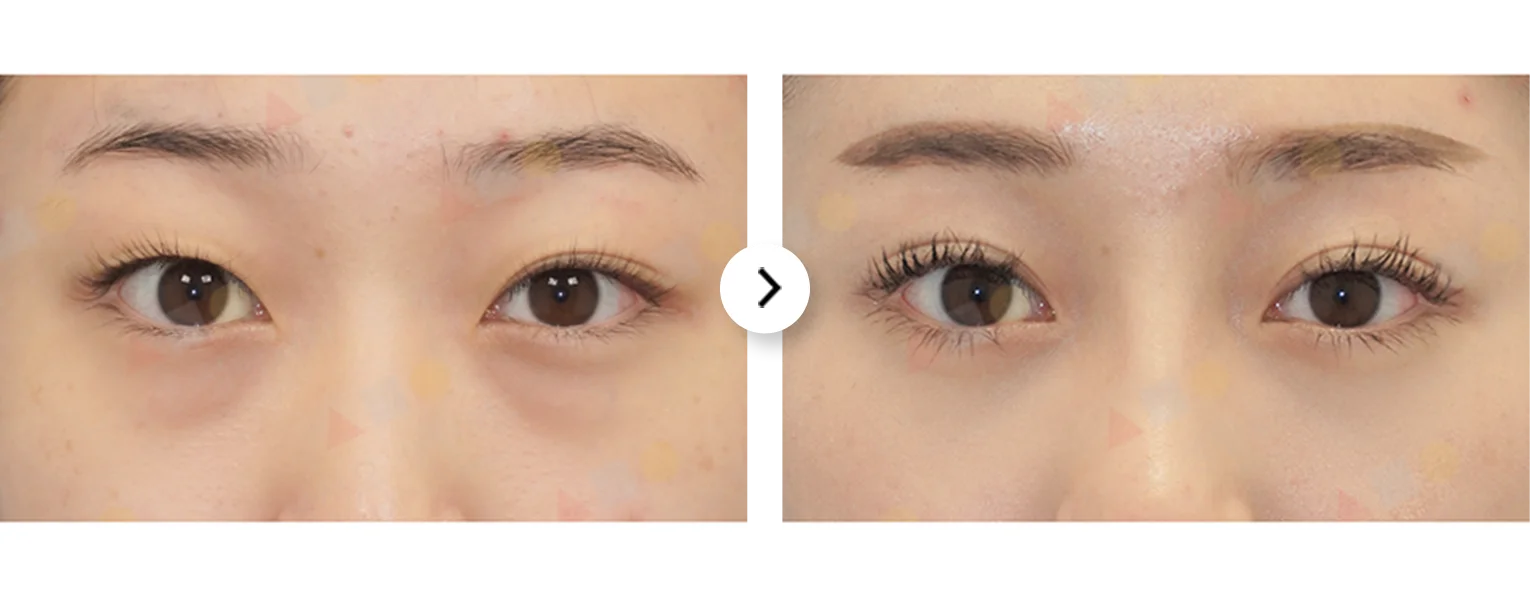 Before and after 345 plastic surgery eyes, showing natural results. Eyelid surgery for a refreshed look.