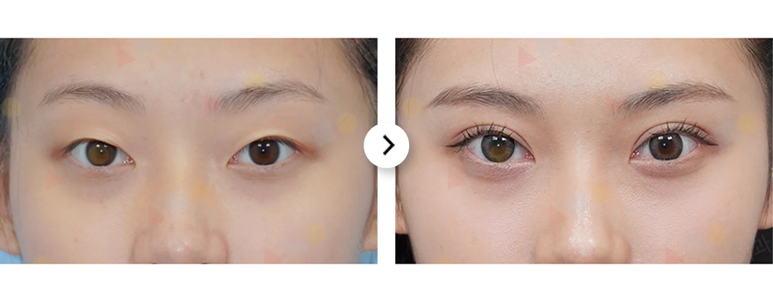Asian woman before and after double eyelid 345 plastic surgery for natural look.